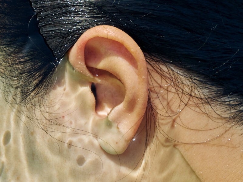 چگونه آب در گوش شناگران را به‌طور ایمن خارج کنیم؟